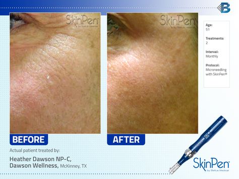 $399 VAMPIRE SPECIAL (MICRONEEDLING W/PRP)