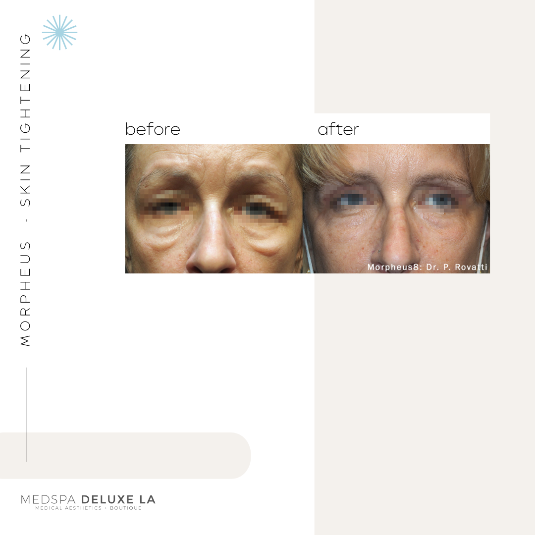 30% OFF: MORPHEUS 8 SPECIAL