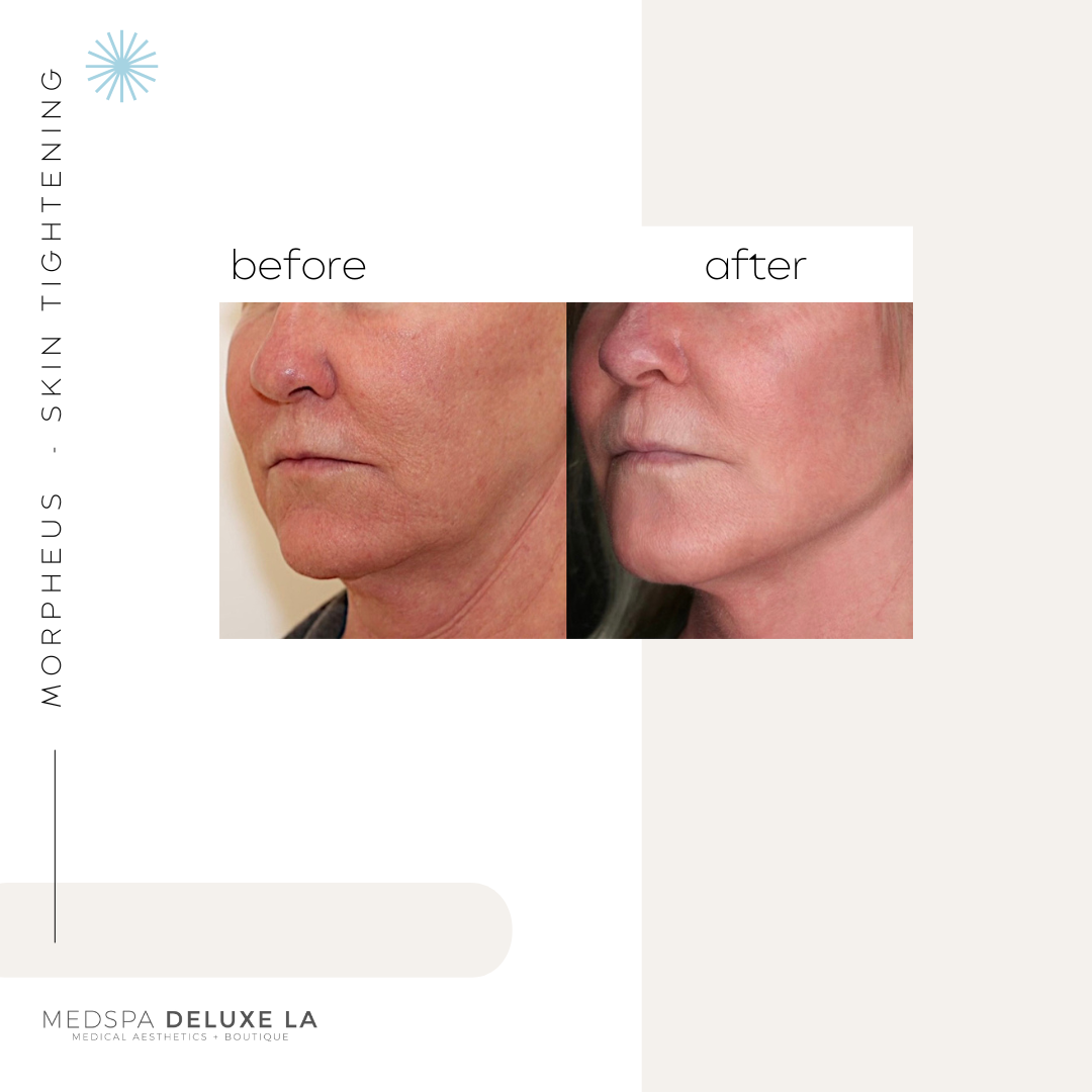 30% OFF: MORPHEUS 8 SPECIAL