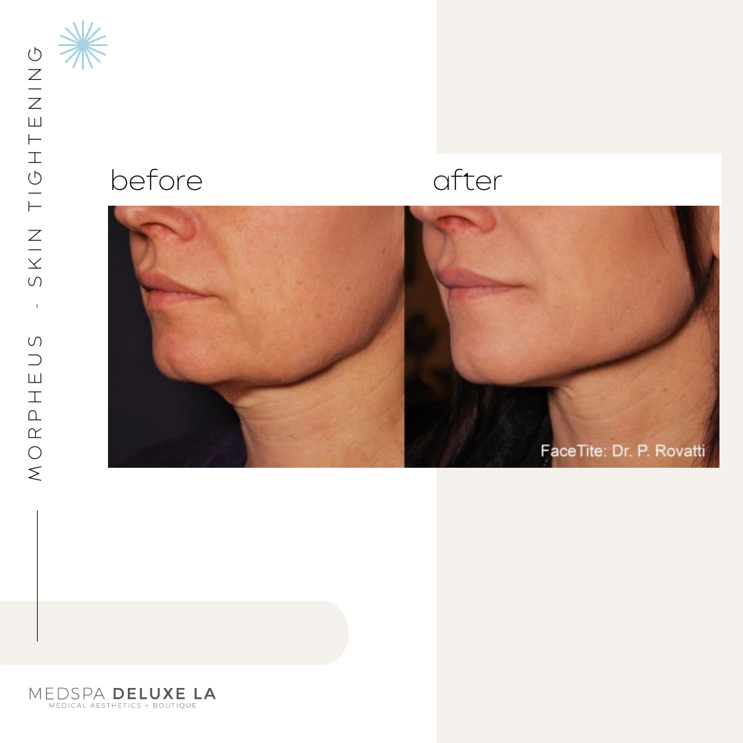 30% OFF: MORPHEUS 8 SPECIAL