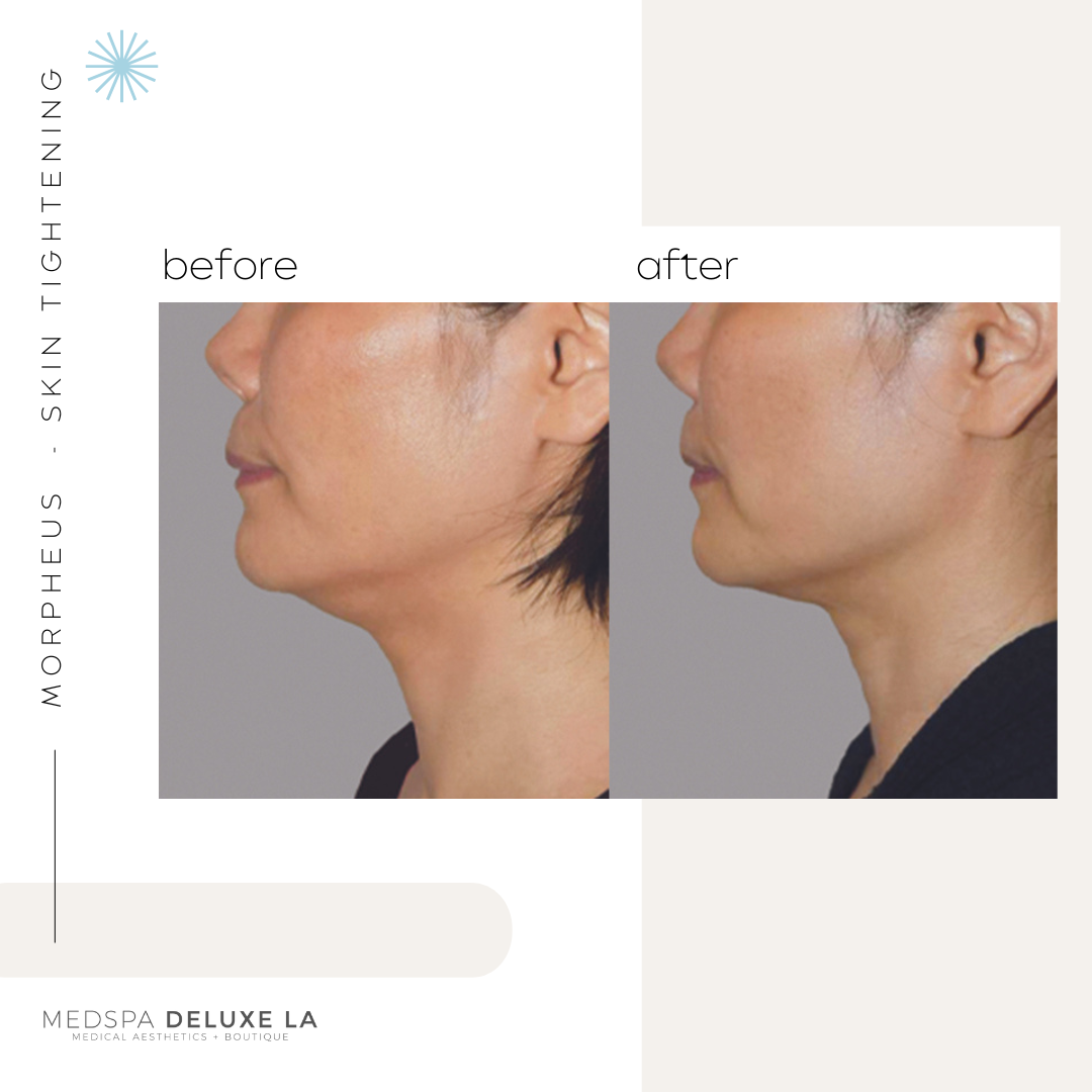 30% OFF: MORPHEUS 8 SPECIAL