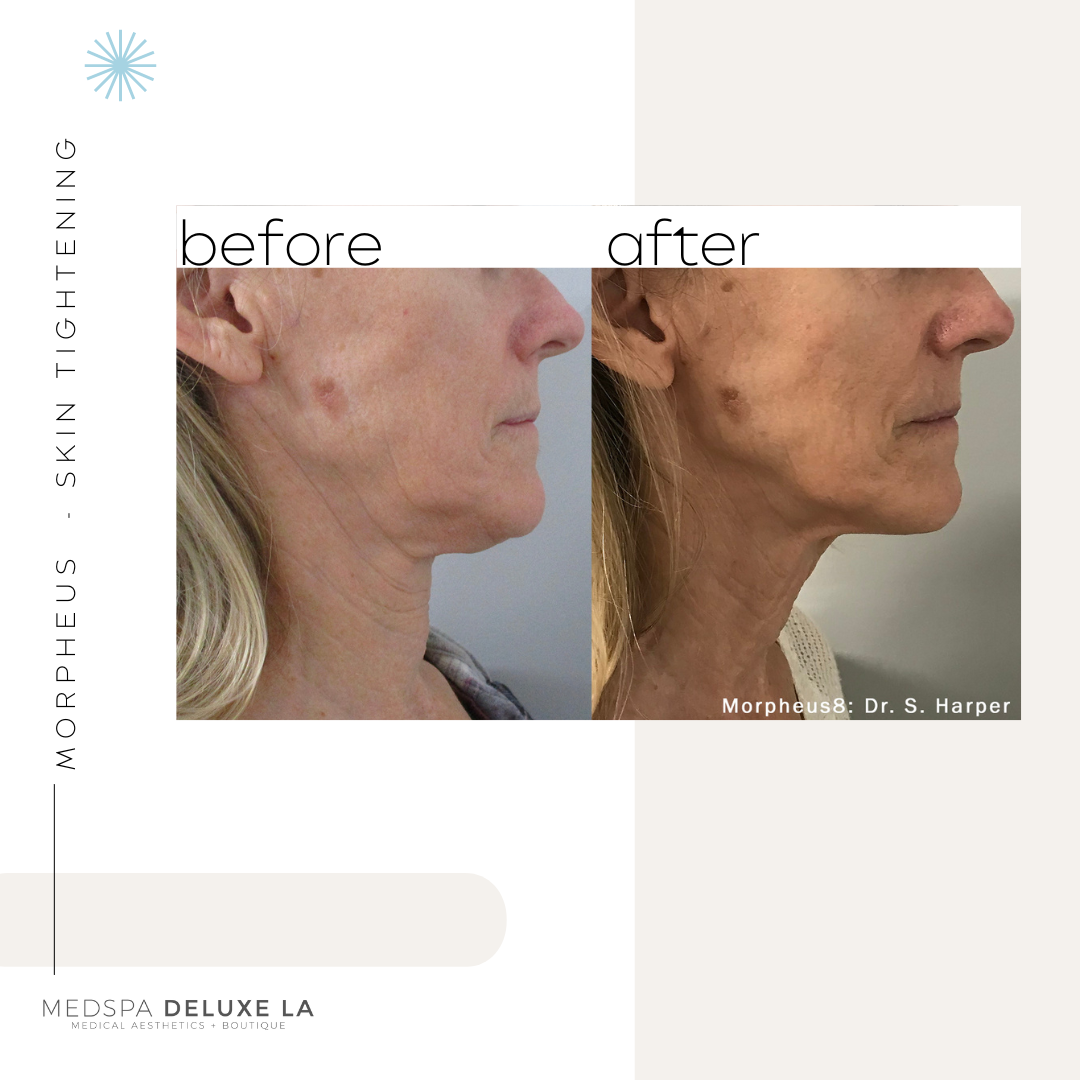 30% OFF: MORPHEUS 8 SPECIAL