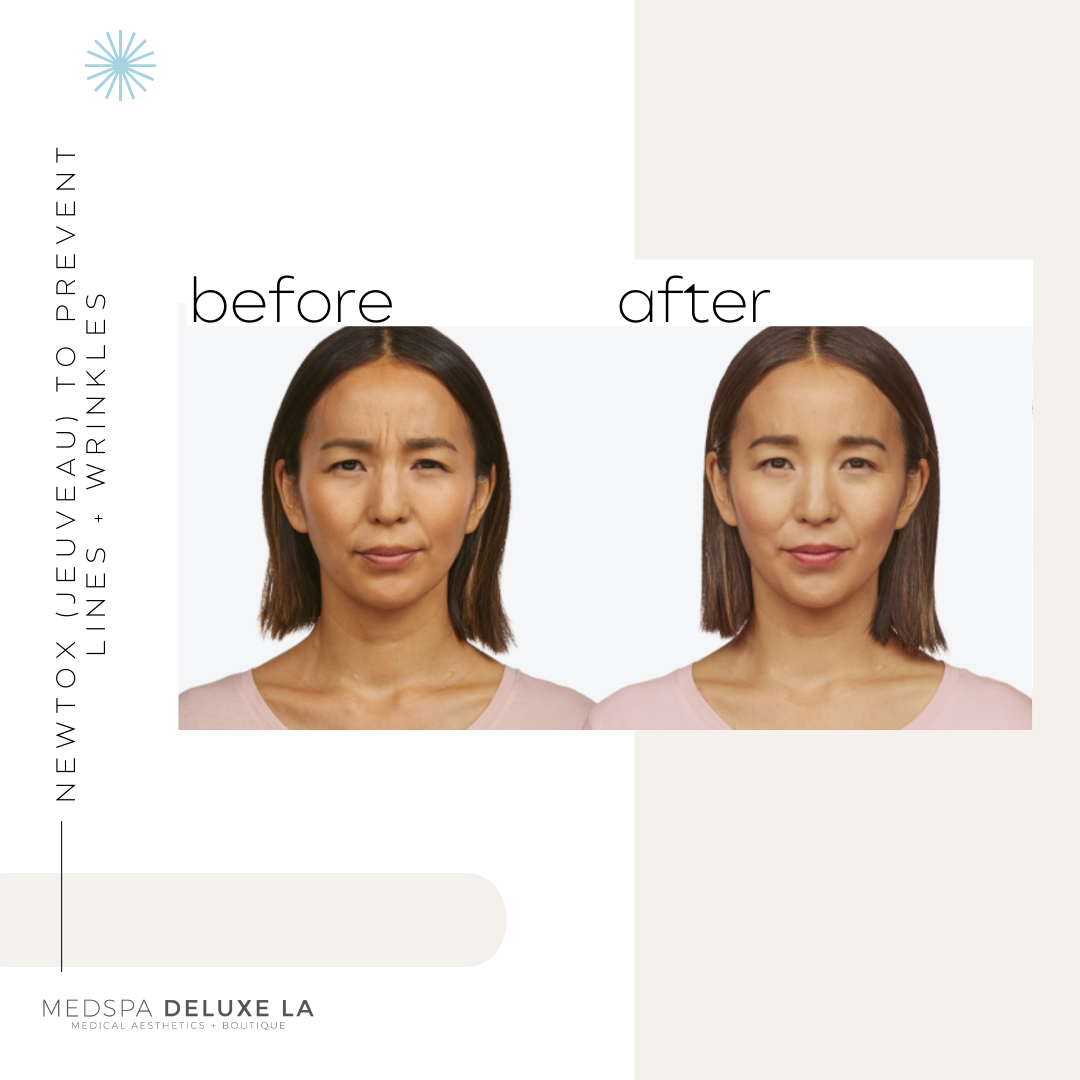 JEUVEAU BUY 55 UNITS GET $55 OFF | APRIL SPECIAL