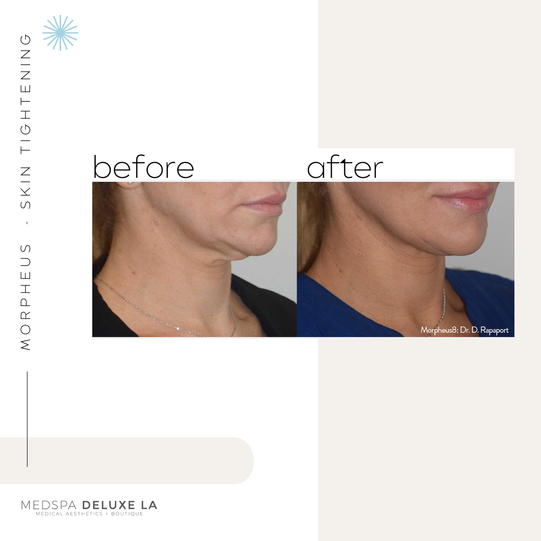 30% OFF: MORPHEUS 8 SPECIAL