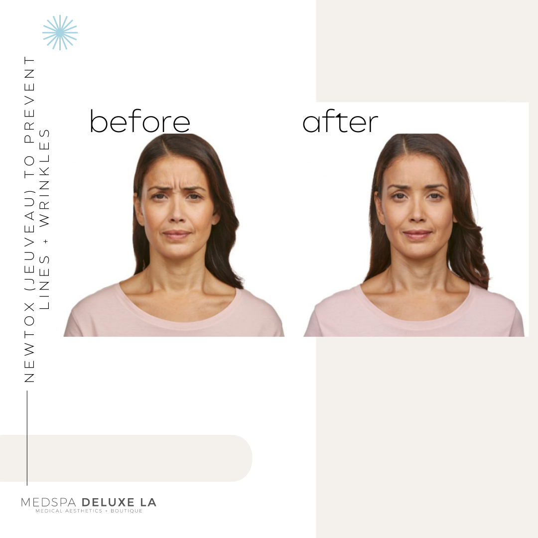 JEUVEAU BUY 55 UNITS GET $55 OFF | APRIL SPECIAL