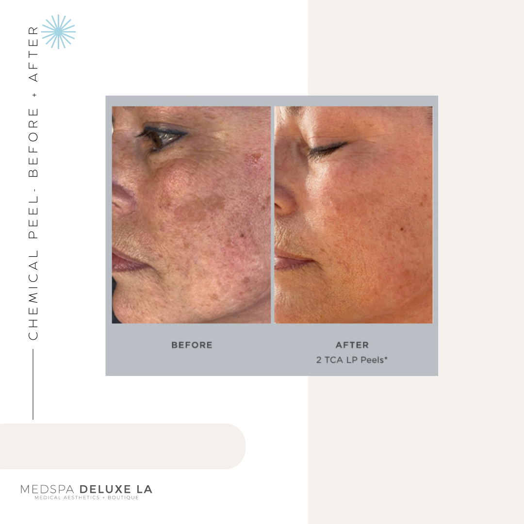 CHEMICAL PEELS -10 YEAR