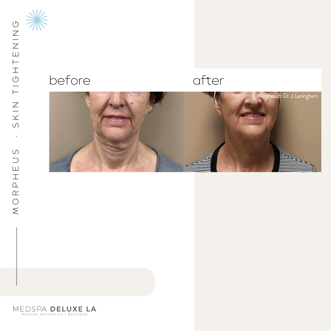 30% OFF: MORPHEUS 8 SPECIAL