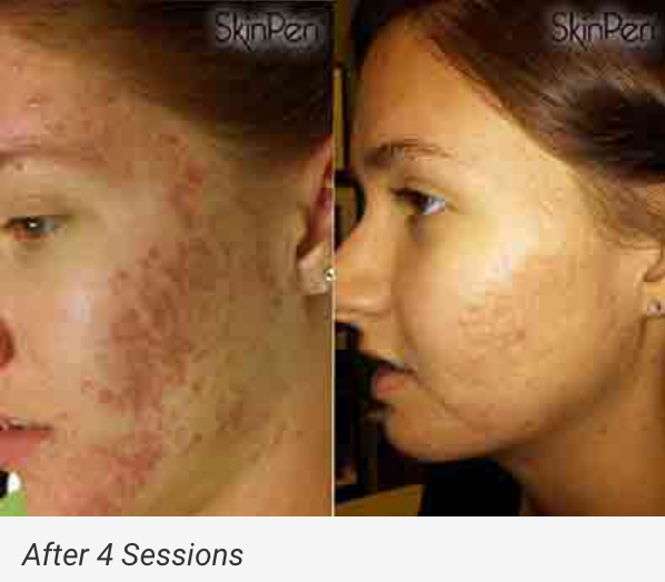 $399 VAMPIRE SPECIAL (MICRONEEDLING W/PRP)