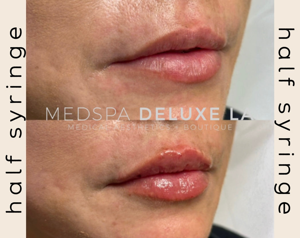1/2 syringe of Lip Filler