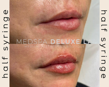 1/2 syringe of Lip Filler