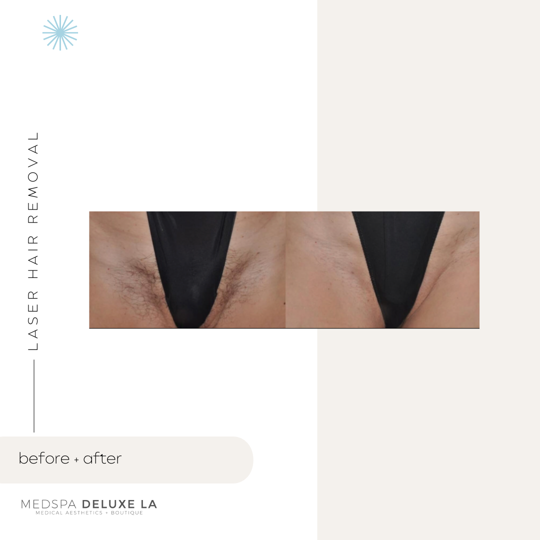 LASER HAIR REMOVAL: UP TO 25% OFF