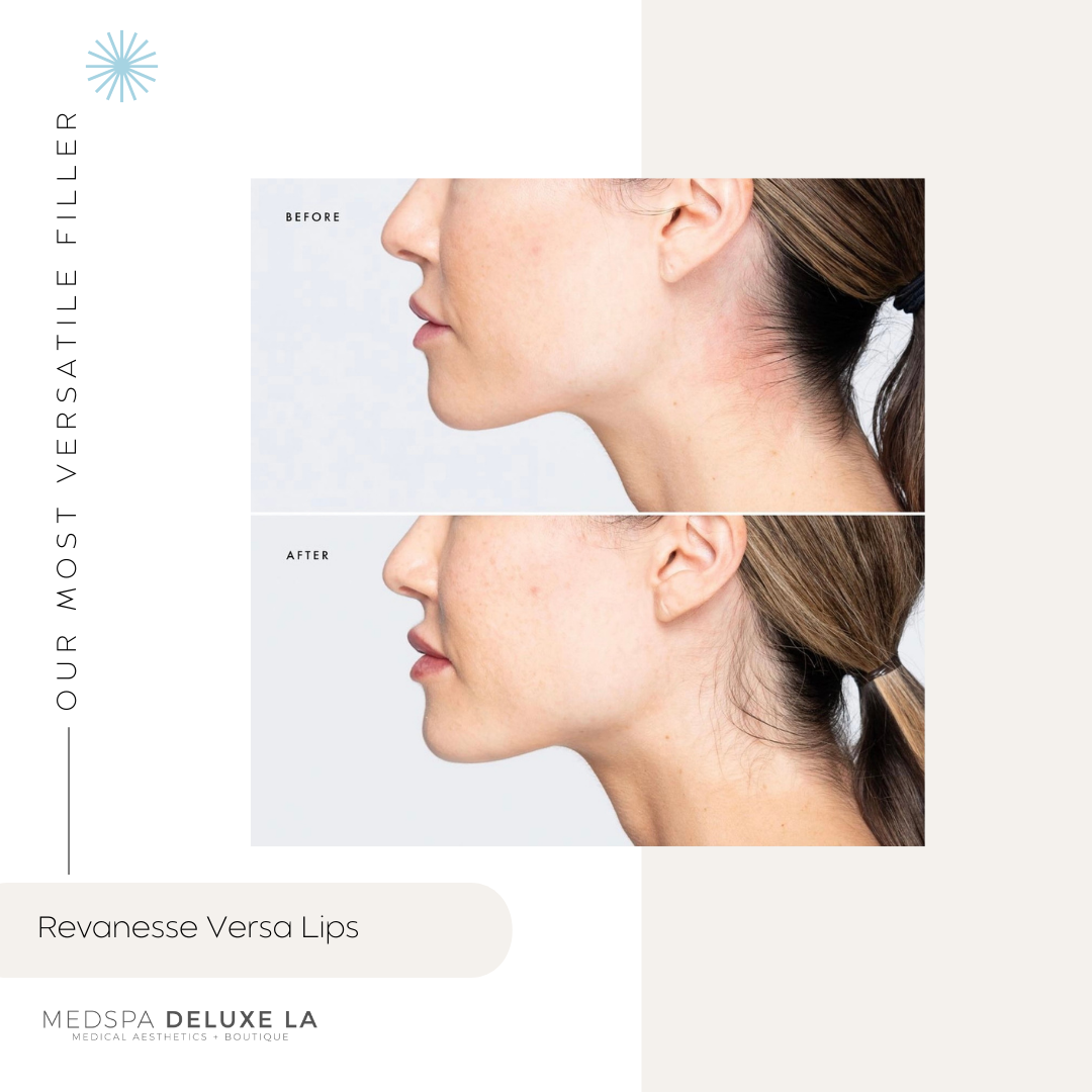 LIP FILLER | FEBRUARY 2026