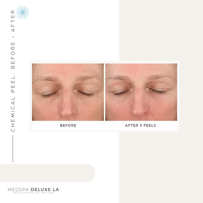 CHEMICAL PEELS -10 YEAR