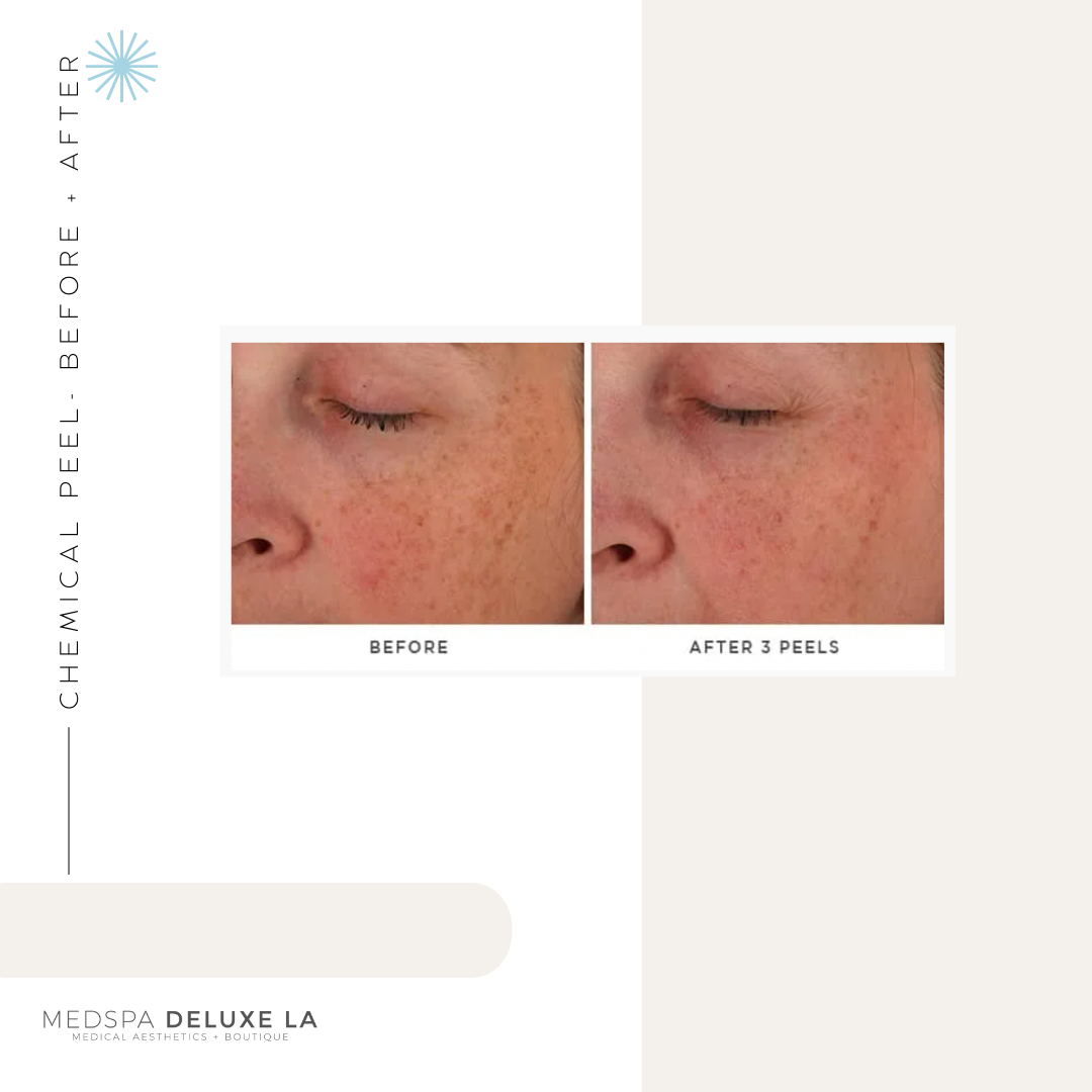 CHEMICAL PEELS -10 YEAR