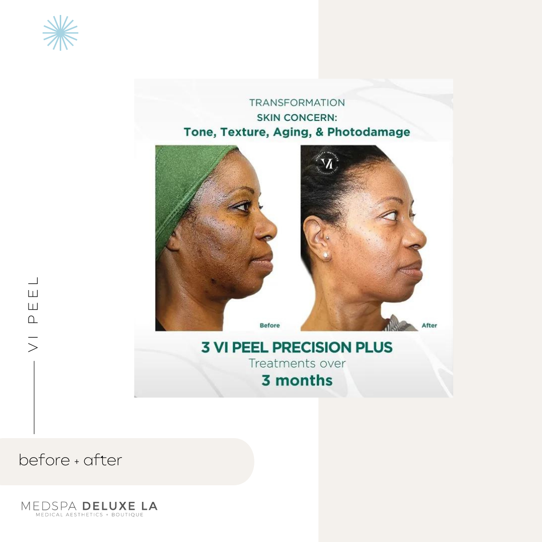 CHEMICAL PEELS -10 YEAR