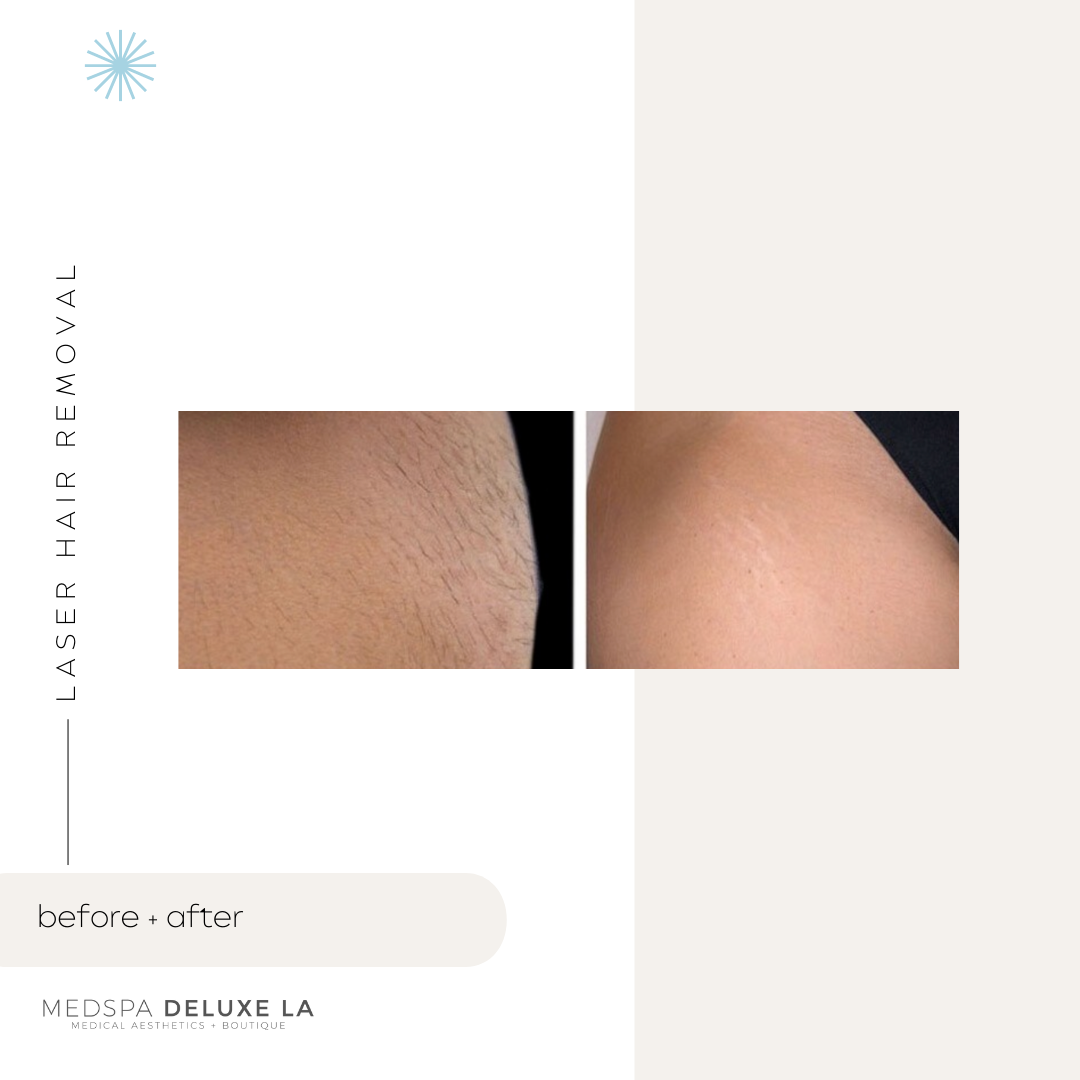 LASER HAIR REMOVAL: UP TO 25% OFF
