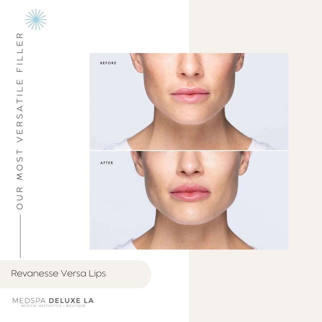 LIP FILLER | FEBRUARY 2026