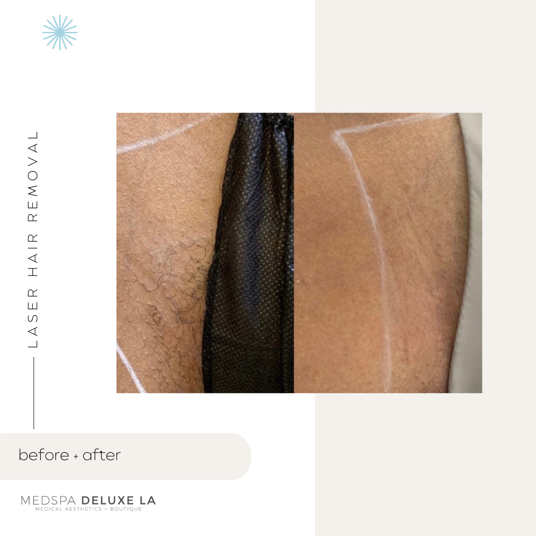 LASER HAIR REMOVAL: UP TO 25% OFF