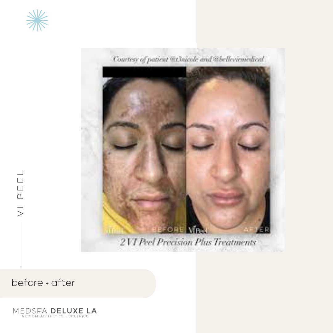 CHEMICAL PEELS -10 YEAR