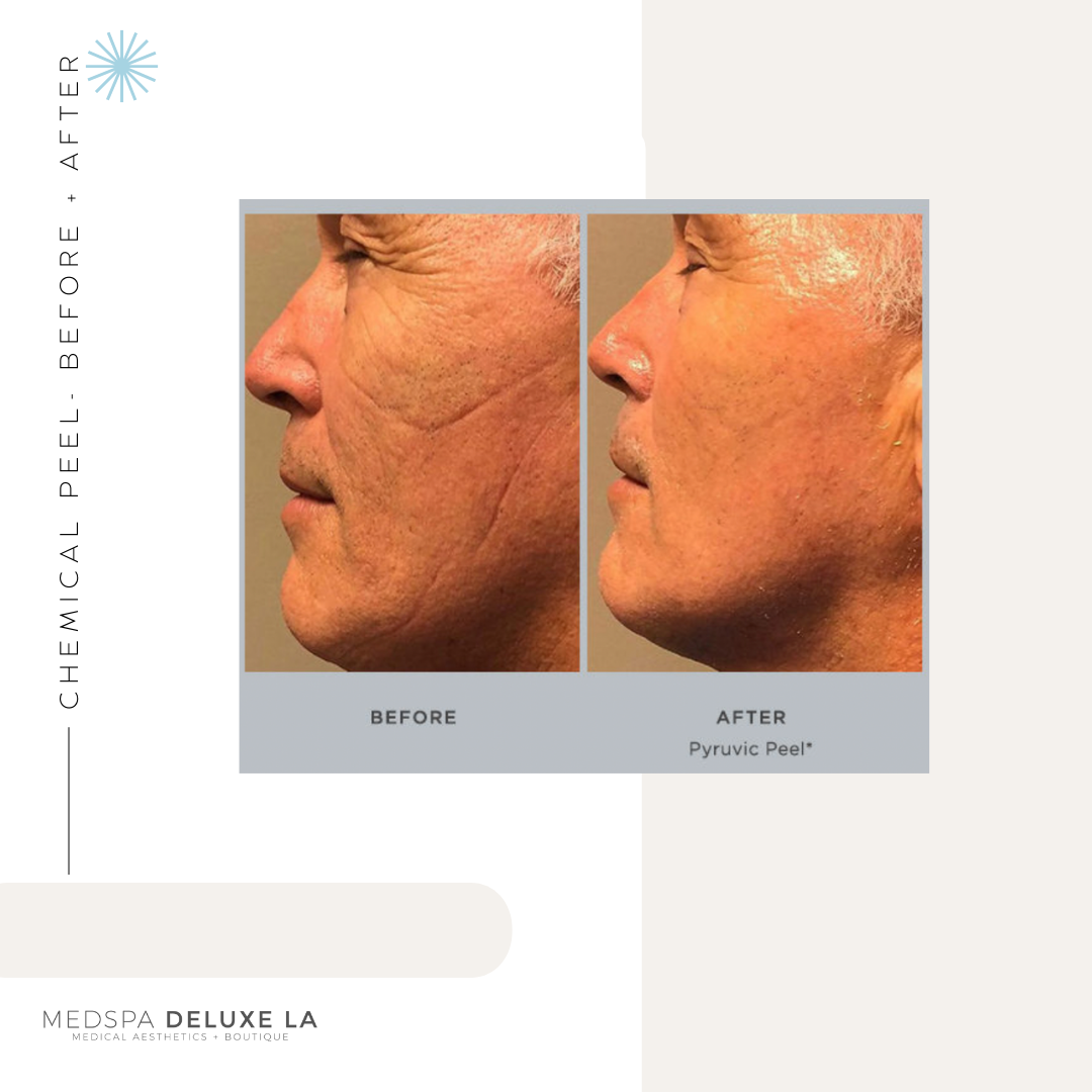 CHEMICAL PEELS -10 YEAR