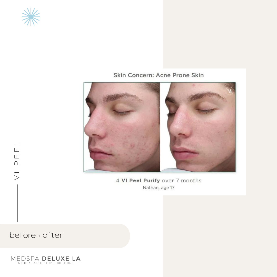 CHEMICAL PEELS -10 YEAR