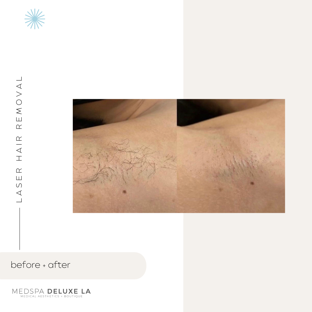 LASER HAIR REMOVAL: UP TO 25% OFF