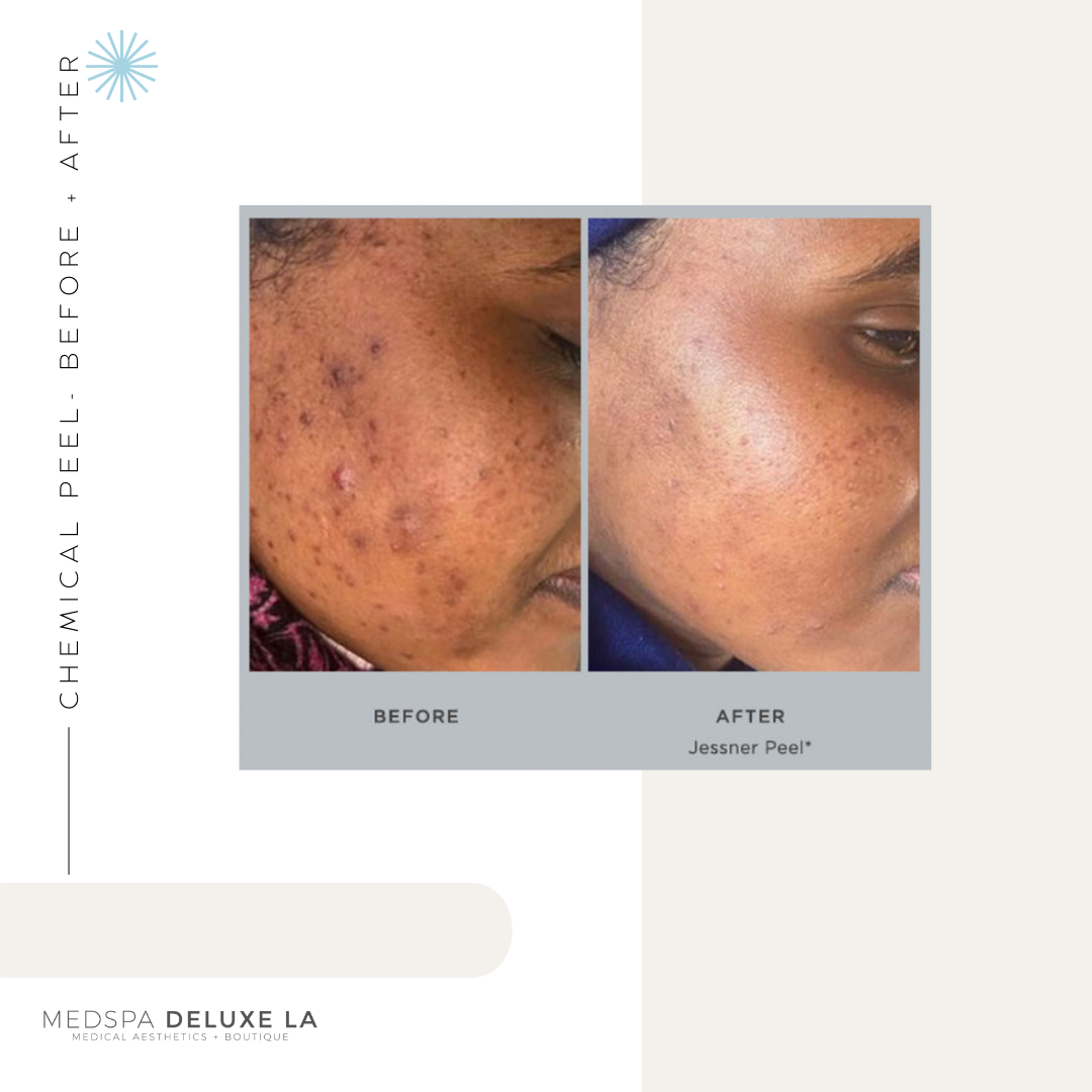 CHEMICAL PEELS -10 YEAR