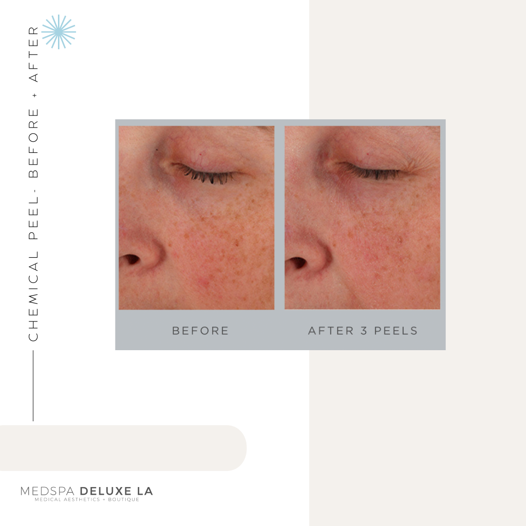 CHEMICAL PEELS -10 YEAR