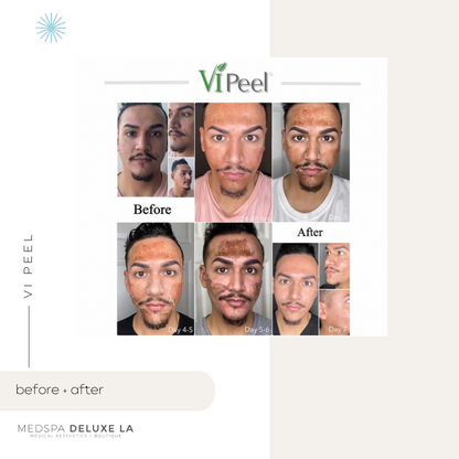 CHEMICAL PEELS -10 YEAR