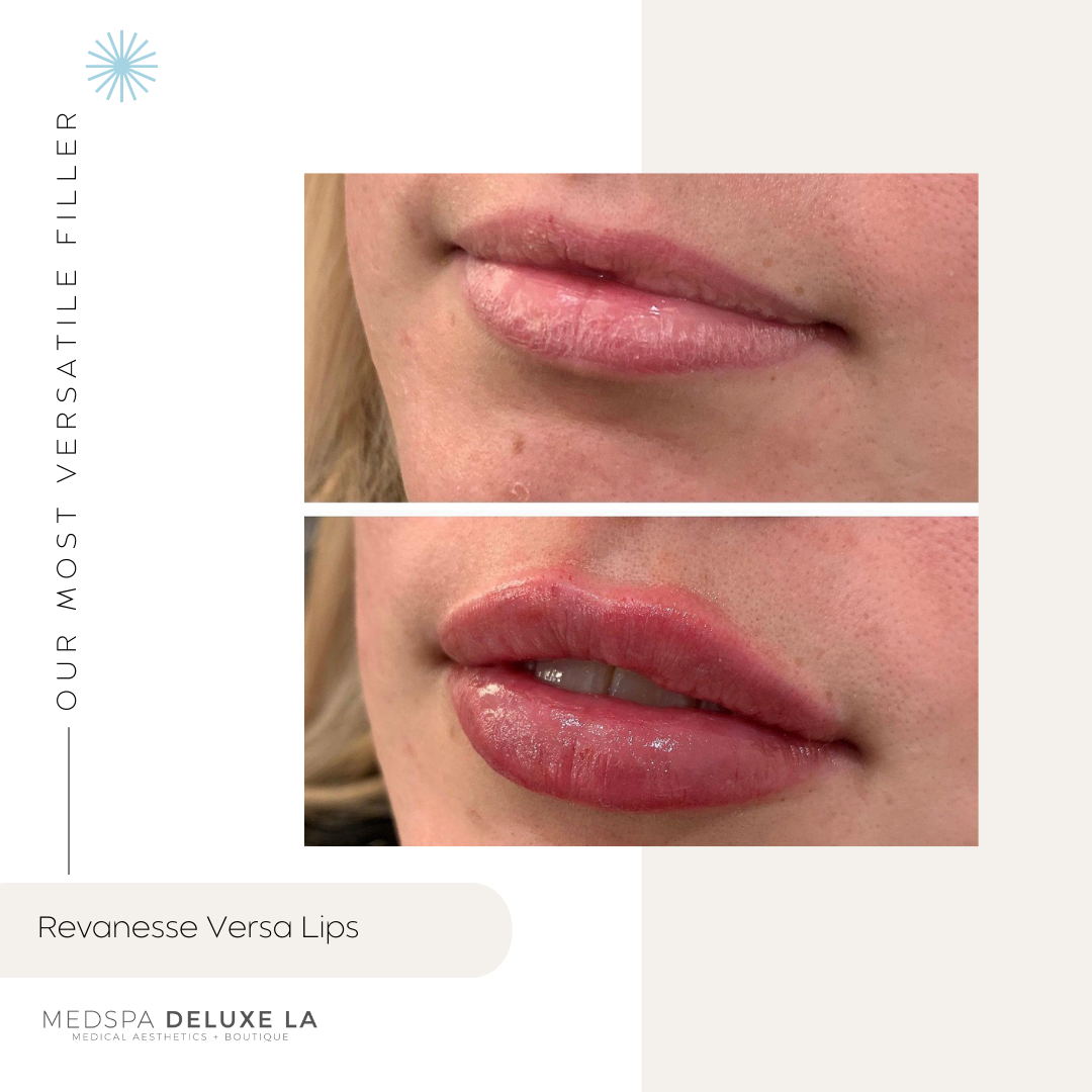 LIP FILLER | FEBRUARY 2026