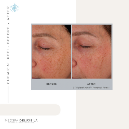 CHEMICAL PEELS -10 YEAR