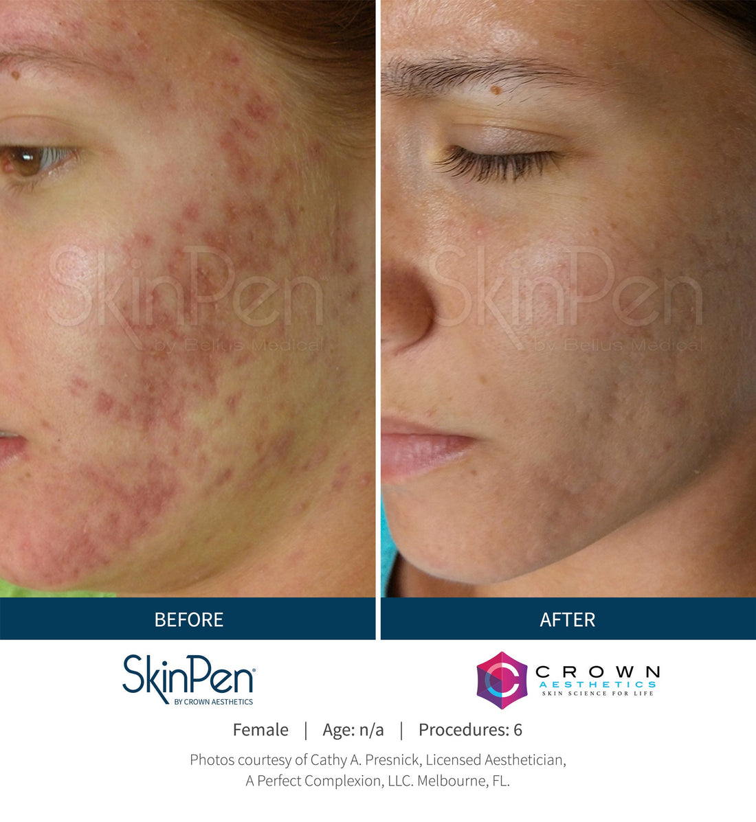 VAMPIRE FACIAL : MICRONEEDLING WITH GROWTH FACTORS: OCTOBER SPECIAL