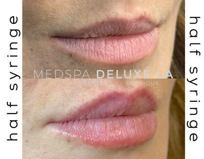 1/2 syringe of Lip Filler