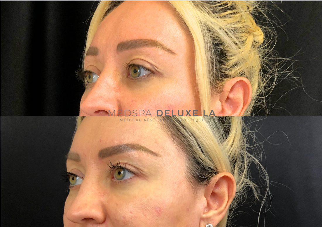 TOX BROW LIFT