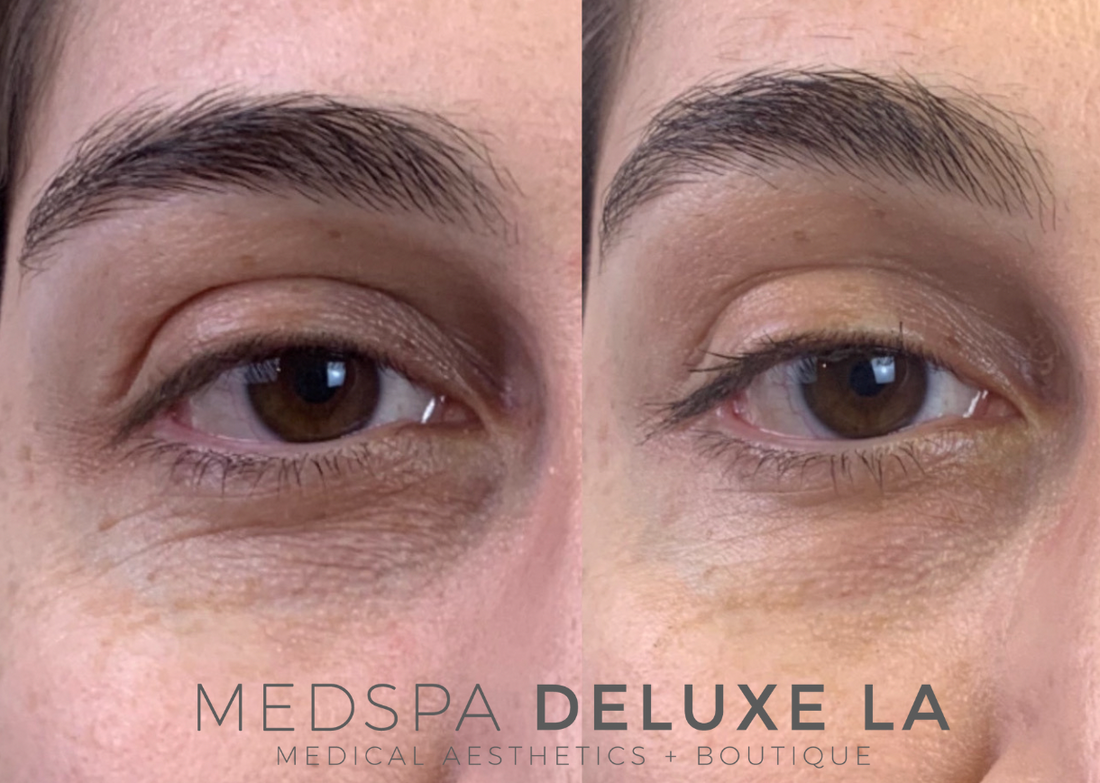 TOX BROW LIFT
