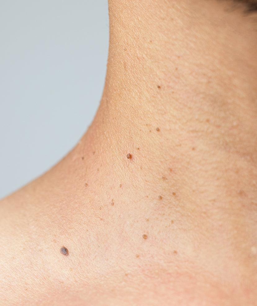 SKIN TAGS - 10 YEAR
