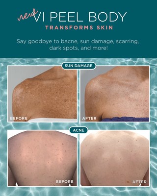 VI PEEL PACKAGES BODY : OCTOBER SPECIAL